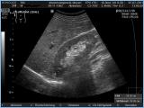Ultraschallbild Niere